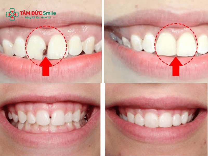 Hiệu quả trước và sau khi trám răng thưa giúp cải thiện Abc8c1 com khuyến mãi hấp dẫn và khép kín khe hở răng