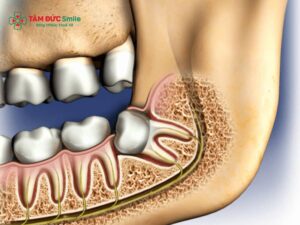 Trước khi nhổ răng khôn có được ăn không? Có cần nhịn ăn?