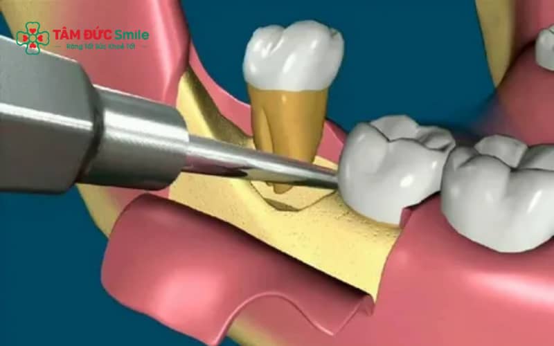 Trước khi nhổ răng khôn, nên ăn nhẹ với thực phẩm dễ tiêu để đảm bảo sức khỏe và tránh mệt trong quá trình thực hiện