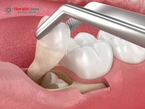Trước Khi Nhổ Răng Khôn Nên Ăn Gì? Lưu Ý Ăn Uống và Chuẩn Bị An Toàn