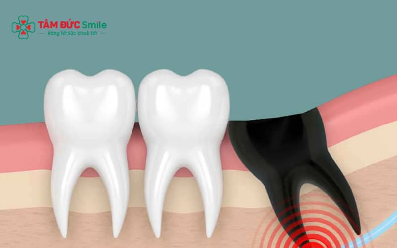 Sau khi nhổ răng khôn, nên ăn thực phẩm mềm và chăm sóc đúng cách để vết thương nhanh hồi phục.
