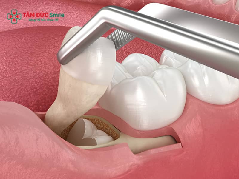 Trước Khi Nhổ Răng Khôn Nên Ăn Gì? Lưu Ý Ăn Uống và Chuẩn Bị An Toàn