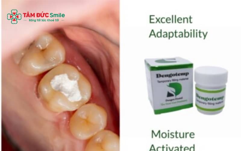 Các sản phẩm trám răng tại nhà như bộ kit hoặc keo trám chỉ mang tính tạm thời, không thay thế Abc8b tỷ lệ kèo World Cup 2026 LINK TRANG CHỦ ABC88 CHUẨN 2026