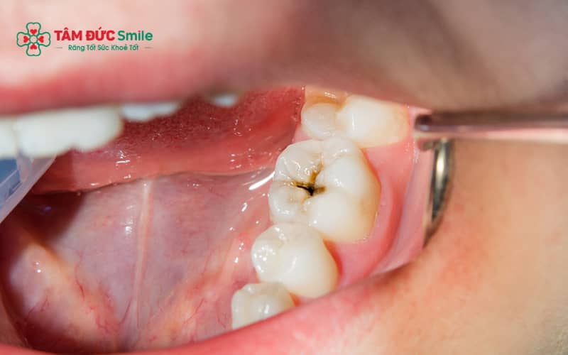 Tự trám răng tại nhà có thể gây viêm nhiễm, làm tình trạng răng trở nên nghiêm trọng hơn