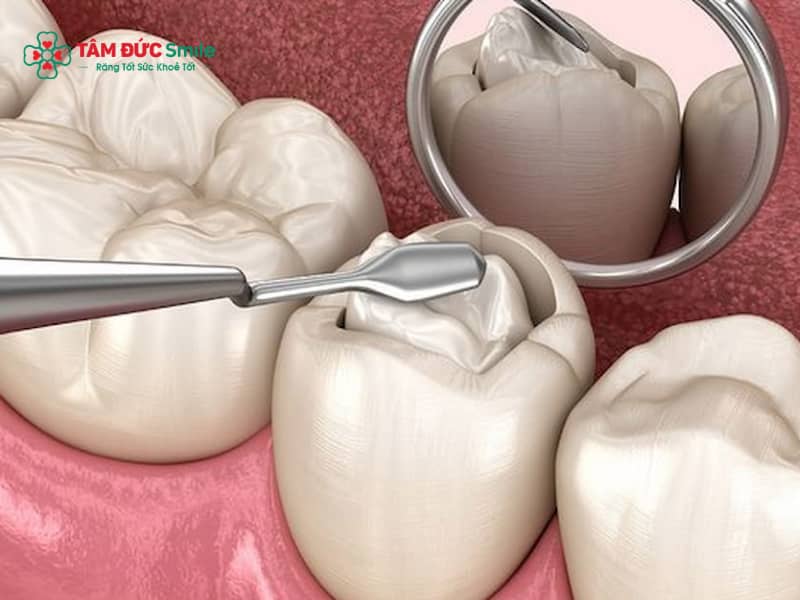 Tự trám răng tại nhà có an toàn không? Keo trám răng, bộ kit trám răng và rủi ro