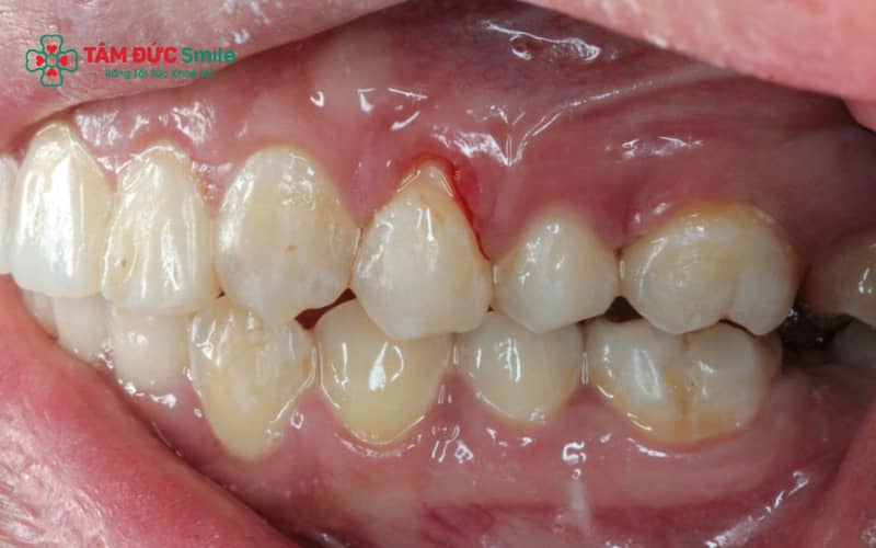 Đánh răng sai cách, Abc8com nổ hũ, viêm lợi và thói quen sinh hoạt ảnh hưởng trực tiếp đến nướu.