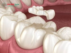 Vật liệu trám răng nào tốt? Composite, Amalgam hay GIC