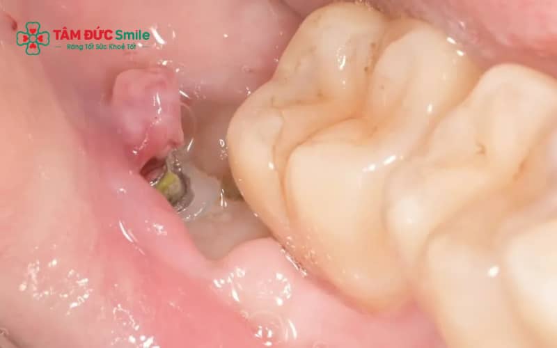 Cục máu đông hình thành tại ổ răng sau khi nhổ là dấu hiệu bình thường, giúp bảo vệ vết thương và hỗ trợ quá trình hồi phục.