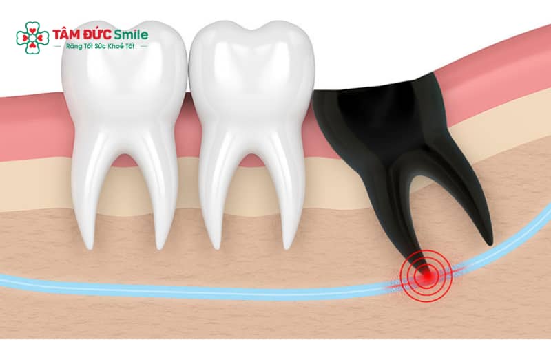 Đau dữ dội, sưng lớn hoặc chảy máu kéo dài là dấu hiệu bất thường sau nhổ răng khôn cần được kiểm tra sớm.