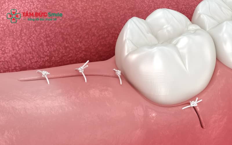 Chăm sóc đúng cách trong 24 giờ đầu giúp bảo vệ vết thương và hạn chế biến chứng sau nhổ răng khôn.