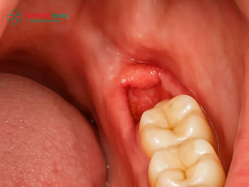 Vết thương sau khi nhổ răng khôn: sưng đau, chảy máu, ổ răng khô