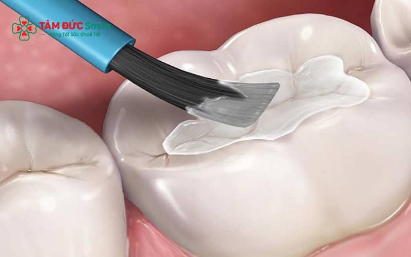 Xi măng trám răng là vật liệu LINK TRANG CHỦ ABC88 CHUẨN 2026 được sử dụng để phục hồi răng bị sâu hoặc tổn thương