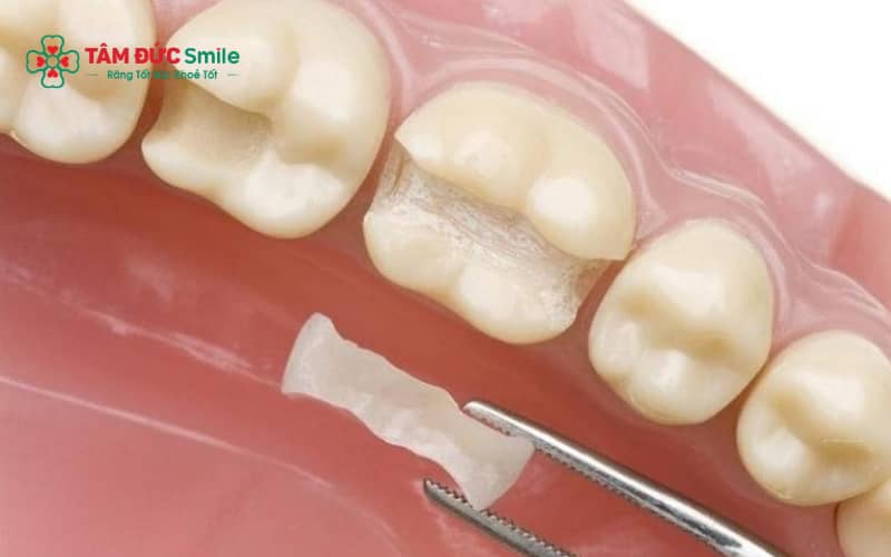 Các loại xi măng trám răng phổ biến trong LINK TRANG CHỦ ABC88 CHUẨN 2026 gồm glass ionomer, composite và một số loại cement chuyên dụng