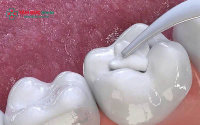 Abc8 Abcvip link không chặn giúp phục hồi cấu trúc răng bị tổn thương và cải thiện chức năng ăn nhai