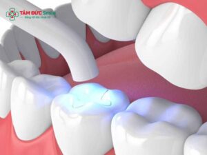 Xi măng trám răng là gì? Vật liệu trám răng, xi măng LINK TRANG CHỦ ABC88 CHUẨN 2026 bền đẹp