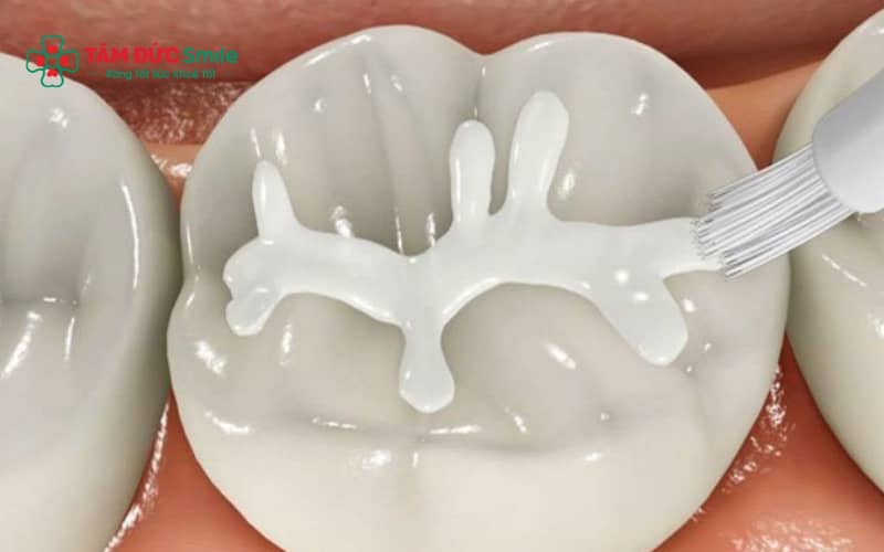 Vật liệu xi măng trám răng được sử dụng trong LINK TRANG CHỦ ABC88 CHUẨN 2026 hiện nay đều phải đáp ứng tiêu chuẩn an toàn y khoa