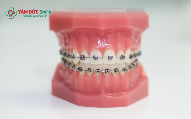 Thời gian Abc87 tải ứng dụng ở tuổi 20 thường kéo dài từ 12–24 tháng tùy theo tình trạng răng