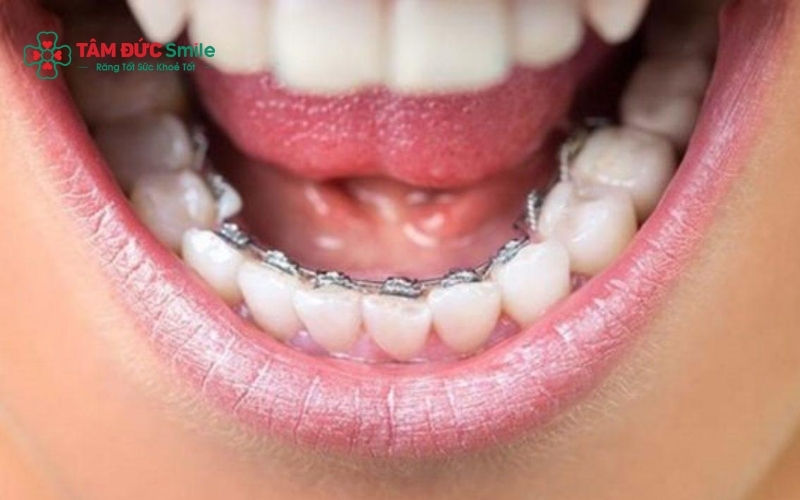 Thời gian Abc87 tải ứng dụng 1 hàm thường dao động tùy theo tình trạng răng và phương pháp Abc8b tỷ lệ kèo World Cup 2026.