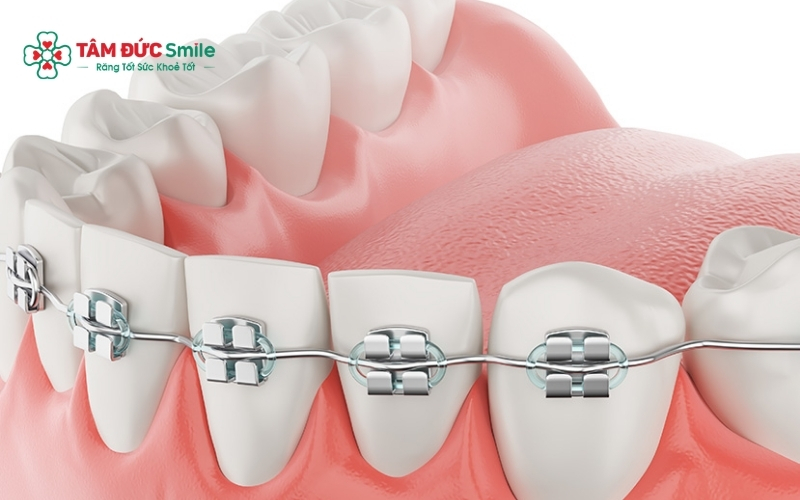 Nhiều yếu tố như mức độ lệch răng, phương pháp niềng và tay nghề ABC8 đường link chính thức ảnh hưởng trực tiếp đến thời gian Abc888k vip truy cập nhanh