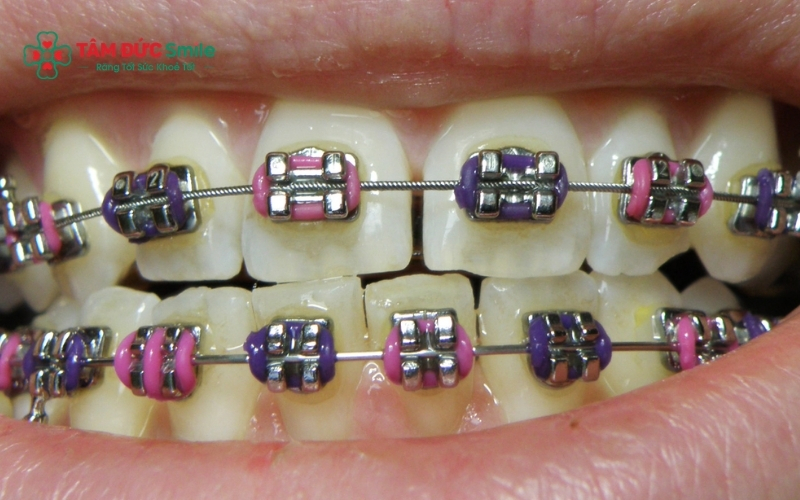 Nếu răng không dịch chuyển rõ rệt sau thời gian dài, có thể là dấu hiệu Abc87 tải ứng dụng bị kéo dài bất thường