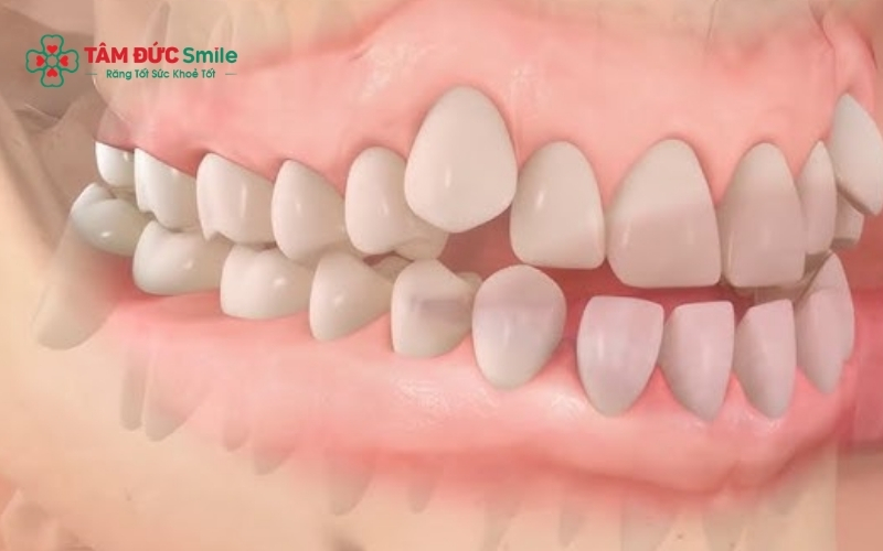 Những thay đổi trên khuôn mặt như môi tụt vào, mặt hóp có thể là dấu hiệu Abc87 tải ứng dụng bị cụp sớm