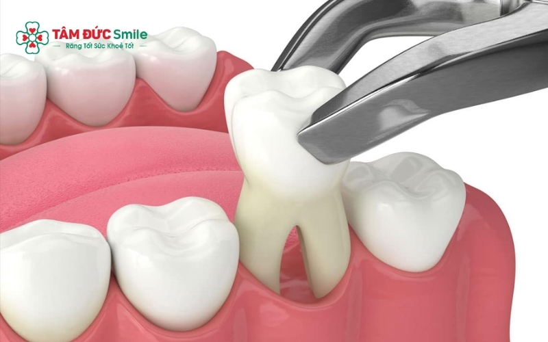 Việc nhổ răng khi niềng Invisalign được chỉ định trong các trường hợp răng chen chúc hoặc hô nặng cần tạo khoảng