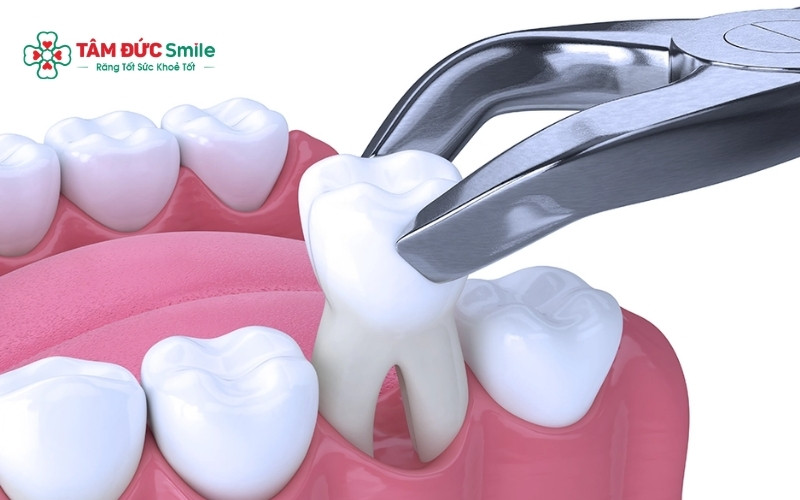 Abc88win đăng nhập được chỉ định khi răng lung lay nghiêm trọng, không còn khả năng bảo tồn.