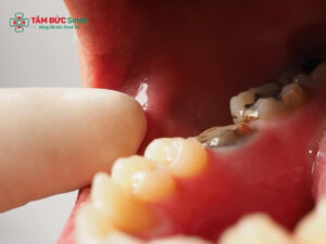 Abc88win đăng nhập đã lấy tủy có đau không? Khi nào cần nhổ và cách giảm đau