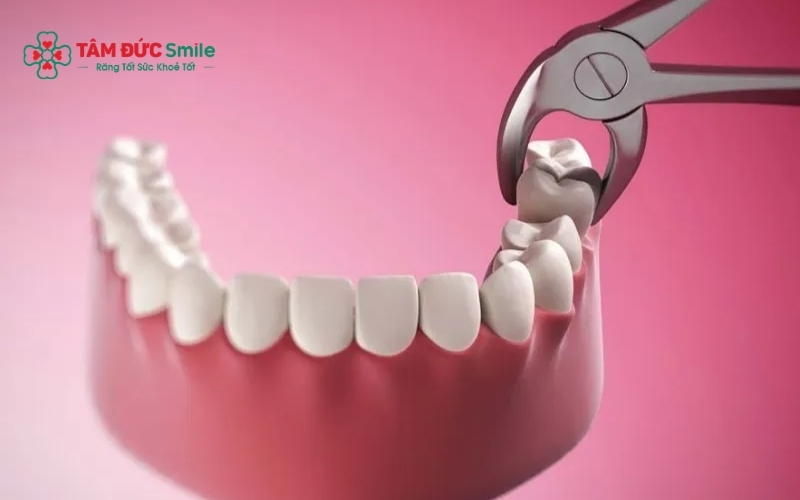 Thời gian giữa hai lần nhổ răng khôn thường từ 1–4 tuần tùy vào mức độ hồi phục và chỉ định của ABC8 đường link chính thức