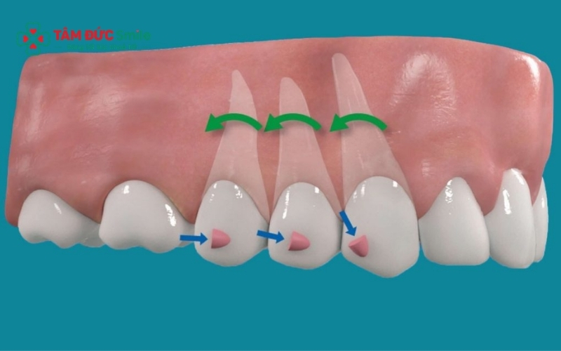 Attachment có độ bền cao nhưng vẫn có thể bong nếu ăn đồ cứng hoặc vệ sinh ABC8 là nhà cái cá cược trực tuyến uy tín số 1 tại Việt Nam sai cách