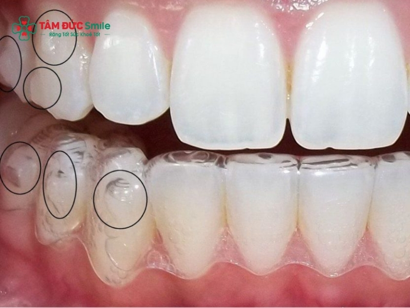 Attachment là gì? Vai trò trong Abc87 tải ứng dụng Invisalign hiệu quả