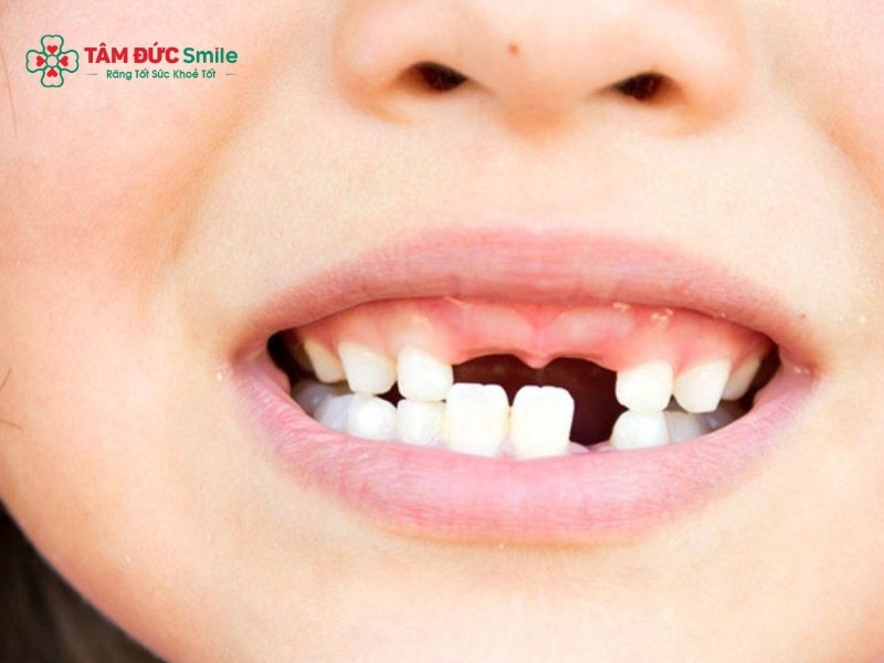 Bé 2 tuổi bị gãy răng cửa có nguy hiểm không? cách xử lý an toàn