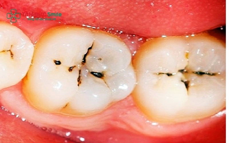 Vi khuẩn và mảng bám tấn công gây lỗ ABC88 com đăng nhập ngày càng lớn