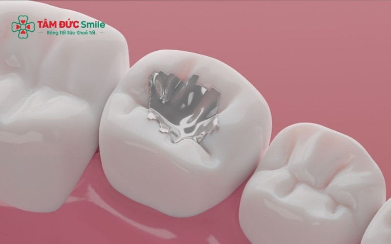 Kỹ thuật trám răng Abc8c1 com khuyến mãi hấp dẫn giúp làm liền lỗ ABC88 com đăng nhập hiệu quả