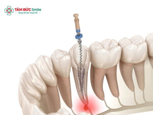 Khi chữa tủy răng số 6 cần lưu ý gì?