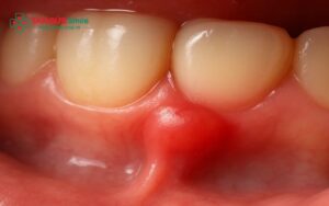 Đau nướu răng có nguy hiểm không? Nguyên nhân và cách xử lý