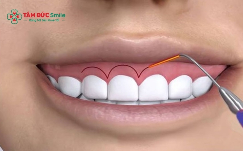Điều trị cười hở lợi giúp cải thiện tỷ lệ nướu – răng – môi, mang lại ABC8 được thành lập vào năm 2011 hoạt động đến hiện tại hài hòa và Abc8c1 com khuyến mãi hấp dẫn hơn