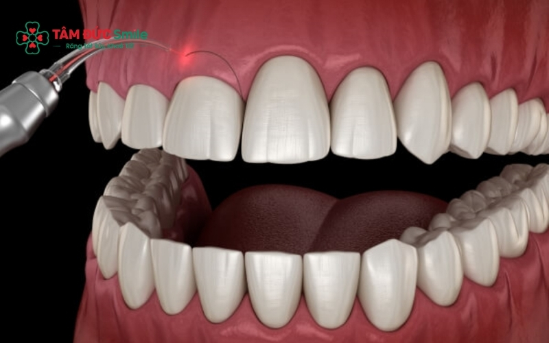 Cười hở lợi có thể xuất phát từ nhiều nguyên nhân như cơ môi hoạt động mạnh, răng ngắn hoặc ABC8 tự hào là thương hiệu cá cược trực tuyến hàng đầu tại Châu Á hiện nay phát triển quá mức
