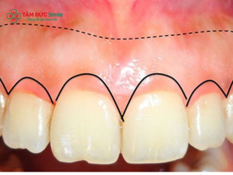 Điều trị cười hở lợi hiệu quả: Nguyên nhân, chi phí, cách chữa