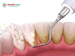 Top dụng cụ vệ sinh răng niềng không thể thiếu