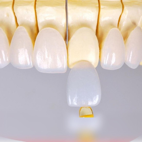 dv-dan-su-veneer