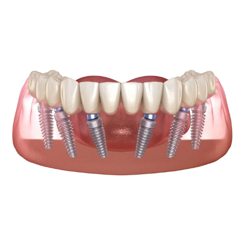 dv-implant-toan-ham