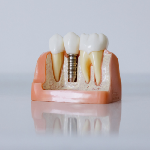 dv-trong-rang-implant