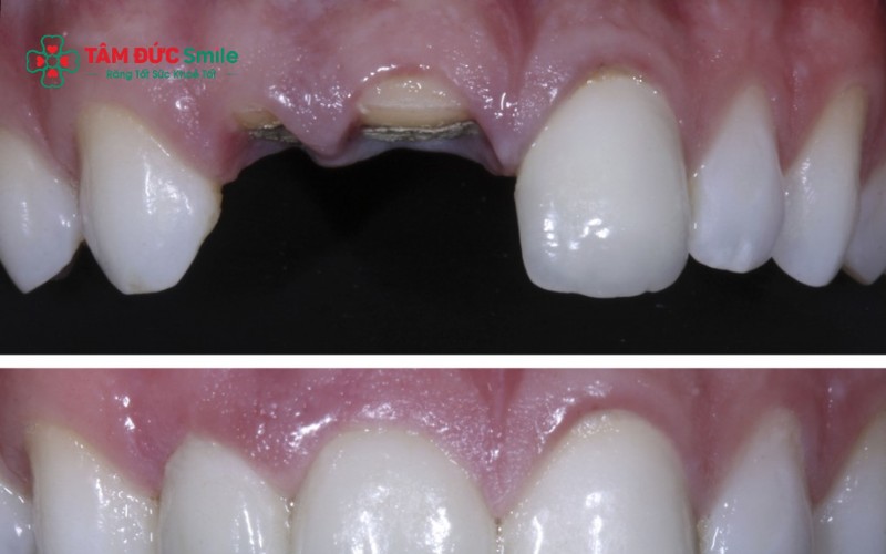 Các phương pháp phục hình mất 2 răng cửa phổ biến hiện nay