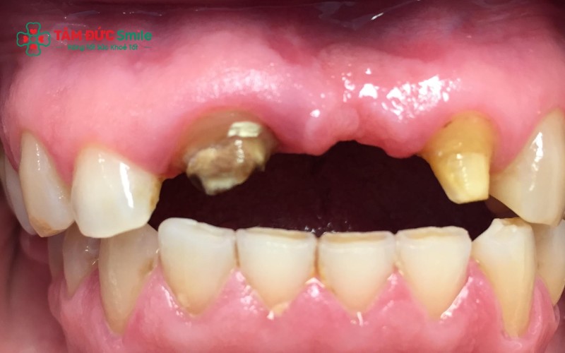 Mất 2 răng cửa có sao không? Giải pháp phục hồi mất 2 răng cửa?
