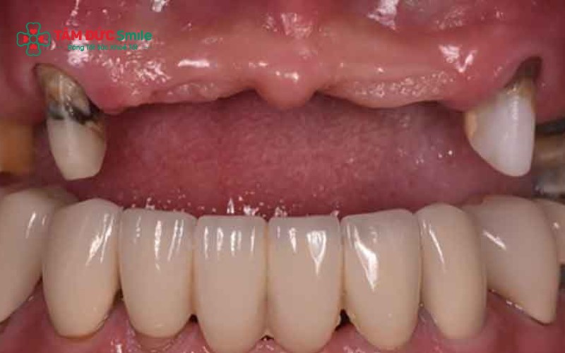 Mất 4 răng cửa có sao không? Giải pháp phục hình tốt nhất?