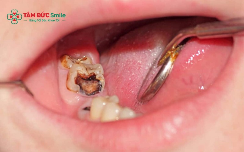 Số lượng và vị trí răng bị mất là yếu tố quan trọng trong việc đánh giá đủ điều kiện