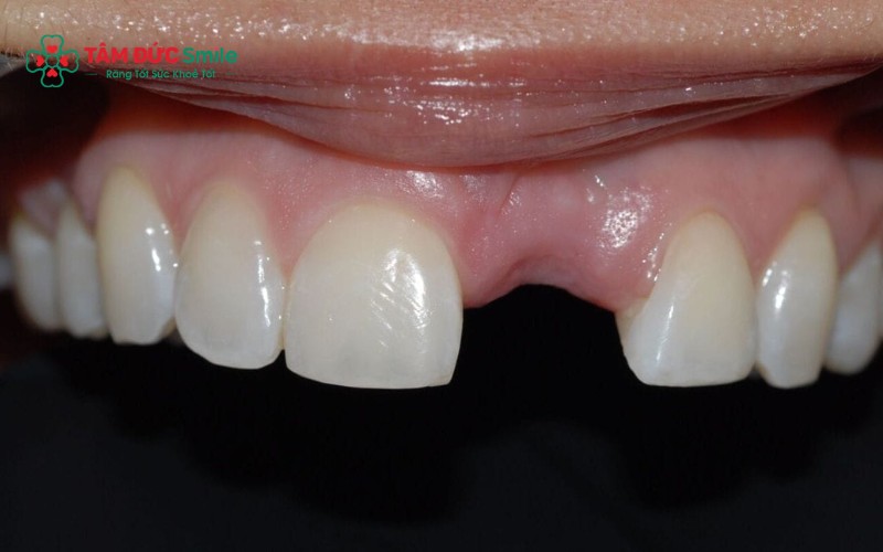 Việc mất răng có ảnh hưởng đến khả năng trúng tuyển nghĩa vụ công an tùy theo mức độ và tiêu chuẩn sức khỏe