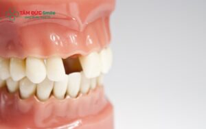 Mất răng số 3 có nguy hiểm không? Phục hồi mất răng số 3 bằng cách nào?