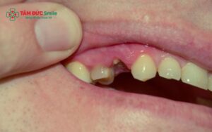 Mất răng số 4 có nguy hiểm không? Giải pháp phục hình mất răng số 4 tốt nhất?